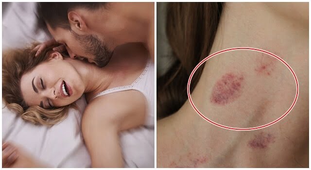 Bệnh Herpes miệng Hickey là gì