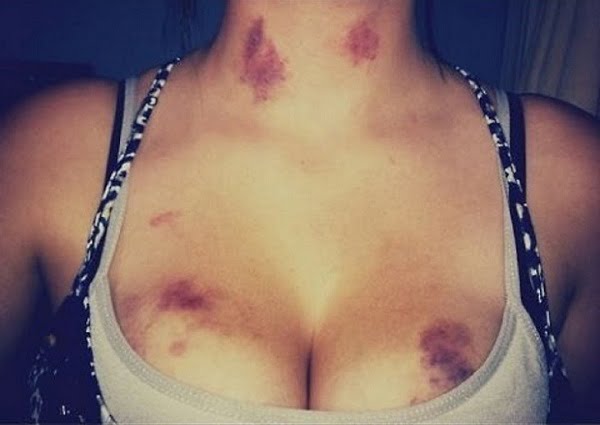 Hickey là gì? Hickey là gì