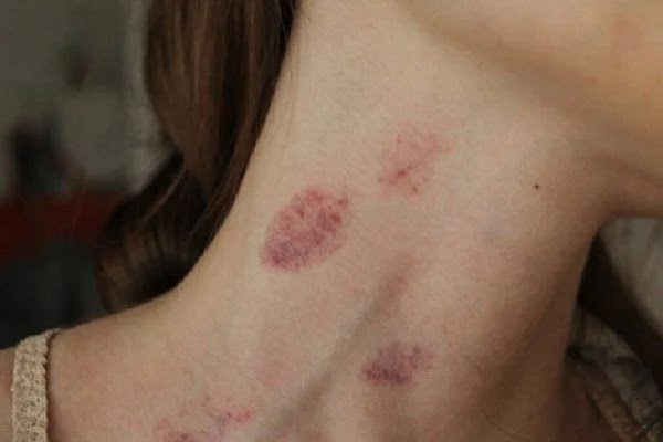 Hickey Hickey là gì