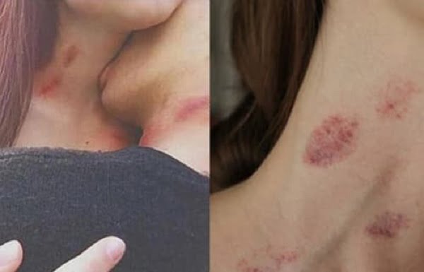 Hickey có hại không? Hickey là gì